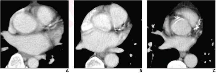 Visual Ordinal Scoring of Coronary Artery Calcium on Chest CT